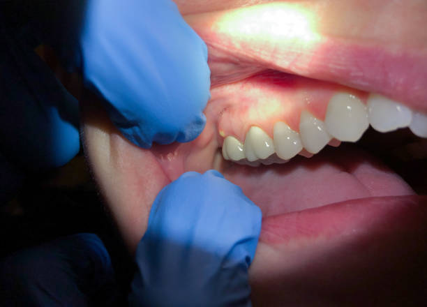 Best Emergency Care for Gum Disease in Lexington, TX